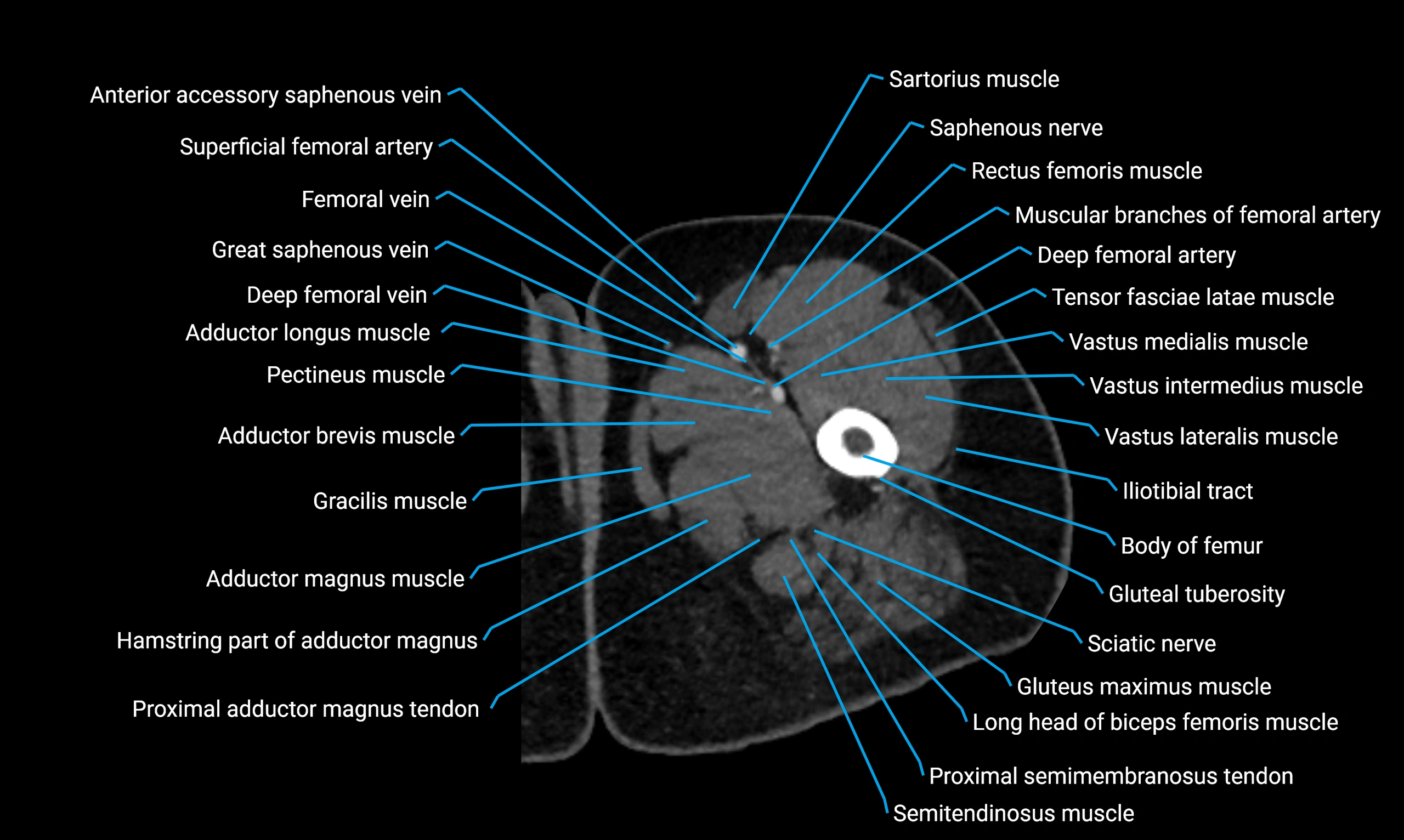 CT lower limb axial cross sectional anatomy labelled image 25 (3).webp